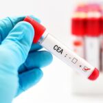 A qué médico acudir con CEA alto: relación con el cáncer