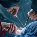 A qué médico acudir para quitar un quiste: Encuentra al mejor especialista