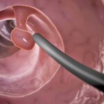 Como se llama el estudio que te hacen por el ano: Colonoscopia