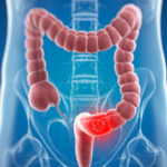 A qué médico acudir si sangro por el ano: síntomas y causas de sangrado rectal