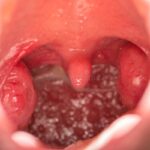 A qué médico ir por dolor de garganta: síntomas y tratamiento